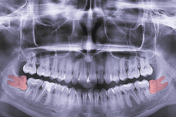 x-ray of teeth, molar tooth improperly growing, absence of the eighth molar